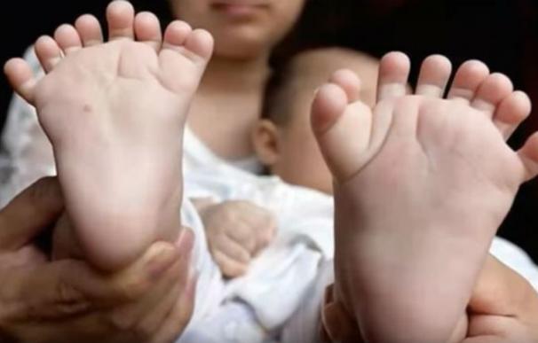 Los padres de un bebé chino con 31 dedos buscan ayuda para poder operarle