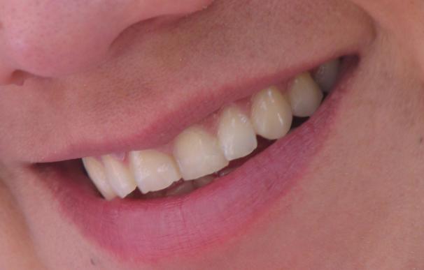 El 34% de los adolescentes y el 24% de los adultos españoles padece sensibilidad dental