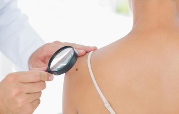 Se diagnostican 4.000 nuevos casos de melanoma cada año en España
