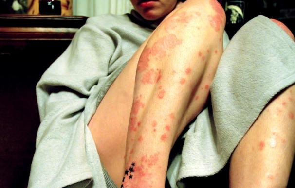 Las enfermedades inflamatorias de la piel, las de mayor carga global entre los trastornos cutáneos