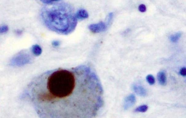 Un nuevo estudio examina cambios genéticos relacionados con la enfermedad de Parkinson