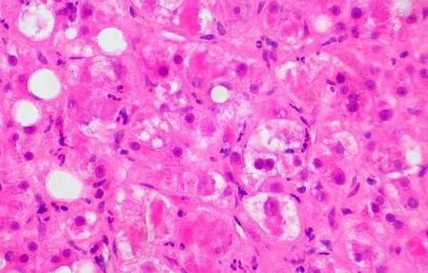 Investigadores del CNIO encuentran un nuevo vínculo entre colesterol, inflamación y cáncer de hígado