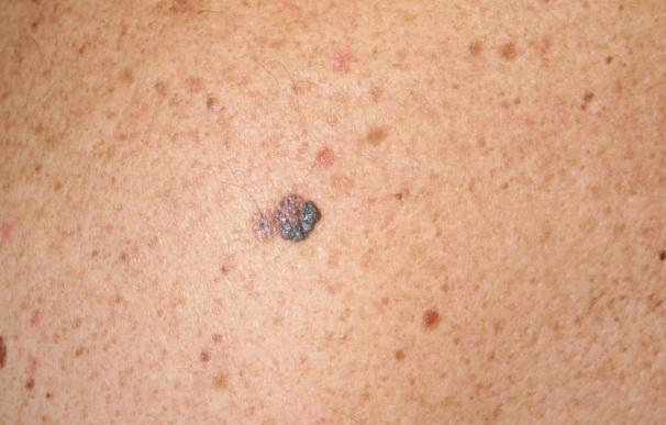 La supervivencia del melanoma supera el 90% después de 5 años gracias a los nuevos tratamientos