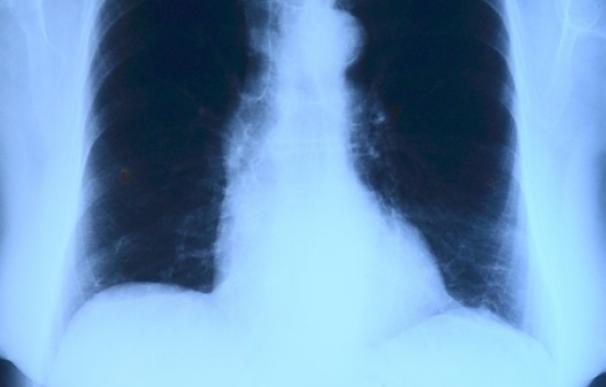 El trasplante pulmonar es una opción cada vez más valorada en todas las patologías respiratorias