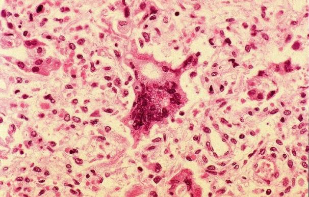 La OMS alerta de que en el último año 35 personas han muerto en Europa por sarampión