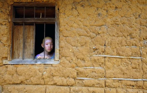 Una exposición fotográfica muestra en Madrid la lucha de los albinos por sobrevivir al sol y la magia en Tanzania