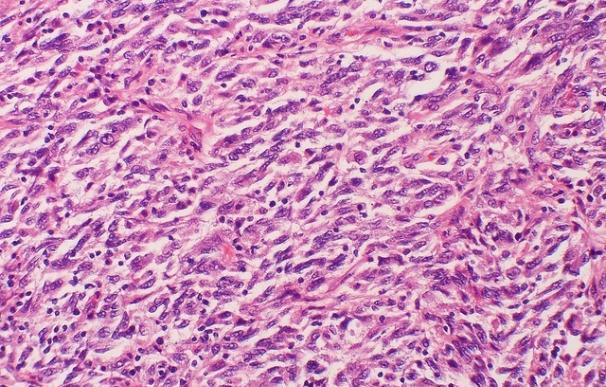 El cáncer puede hacer metástasis sin afectar a los ganglios linfáticos cercanos