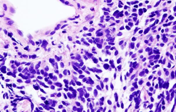 Vista microscópica de una biopsia de carcinoma de pulmón de células pequeñas