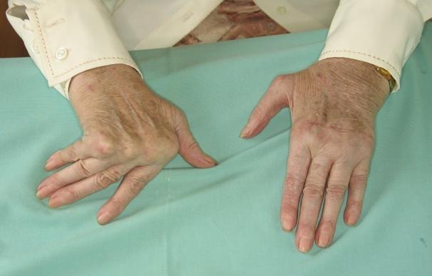 La cirugía puede acabar con las deformidades y problemas en las manos asociados a la artritis reumatoide