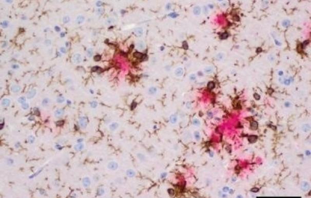 Nuevas variantes genéticas vinculan el sistema inmune con el desarrollo del Alzheimer