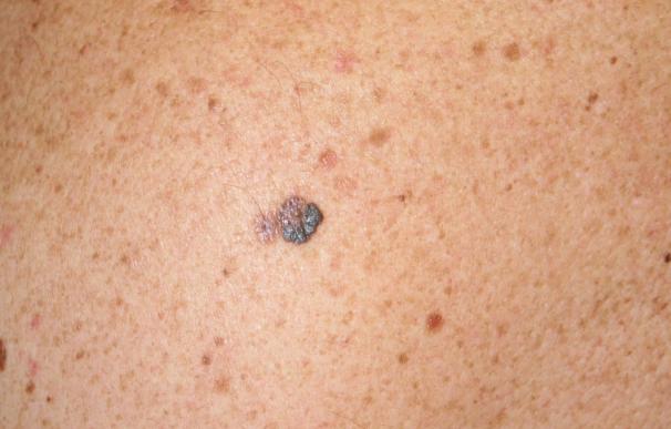 La combinación de dos inmunoterapias logra retrasar casi un año la progresión del melanoma avanzado
