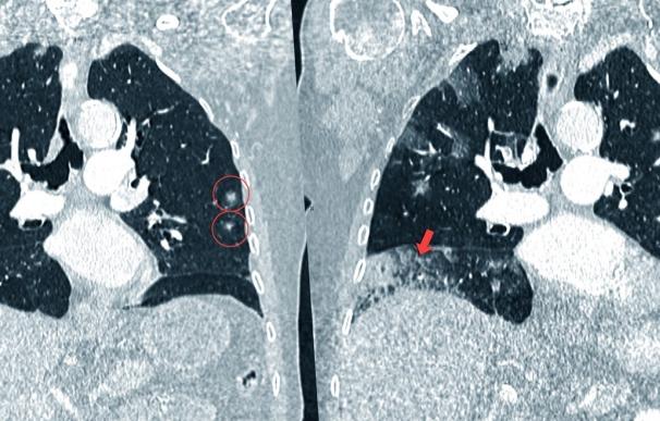 La tomografía computarizada de baja radiación permite detectar el cáncer de pulmón en las fases más precoces