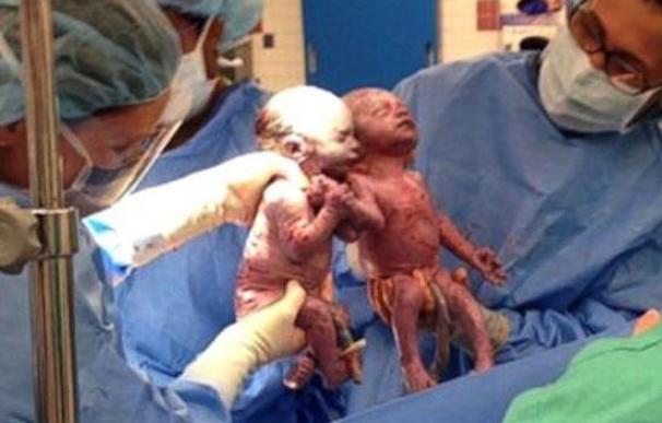 Dos gemelas nacen cogidas de la mano