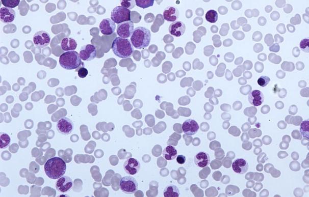 Investigadores detectan vulnerabilidades de las células de leucemia mediante la técnica de edición del gen