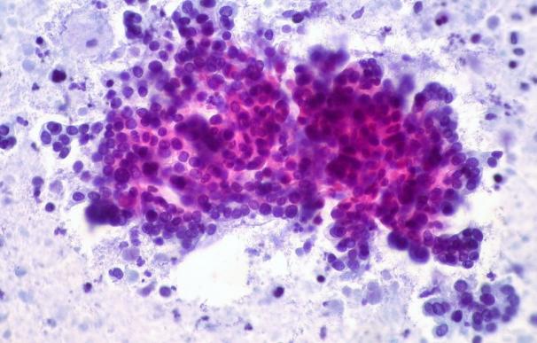 El cáncer de páncreas podría estar provocado por un 'big bang' de alteraciones genéticas
