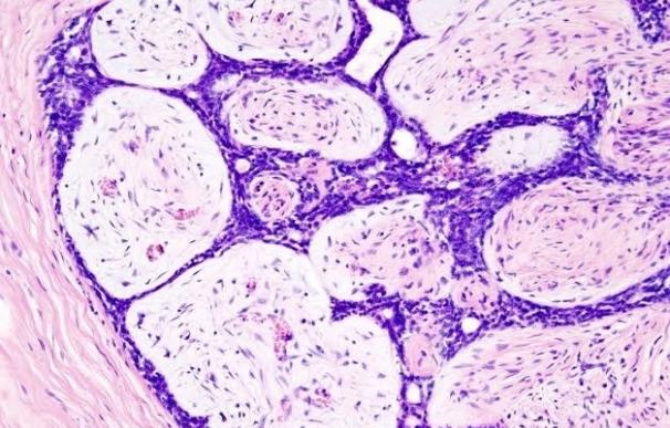 Investigadores españoles hallan cambios genéticos en los tumores de mama hormonales que reaparecen con metástasis