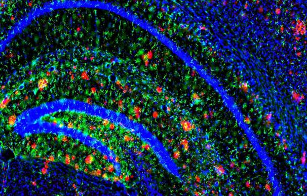 Un nuevo anticuerpo monoclonal consigue resultados prometedores en fases iniciales del Alzheimer