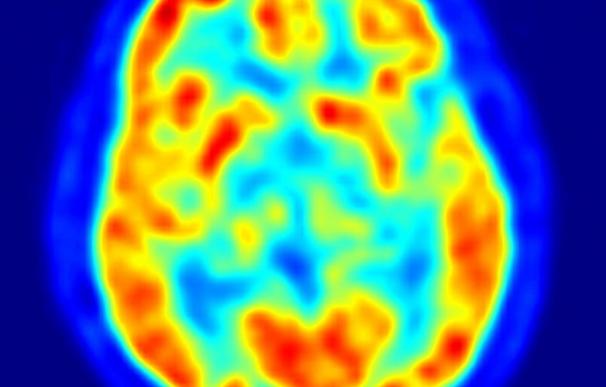 Logran ralentizar la formación de las placas que matan las células en el Alzheimer