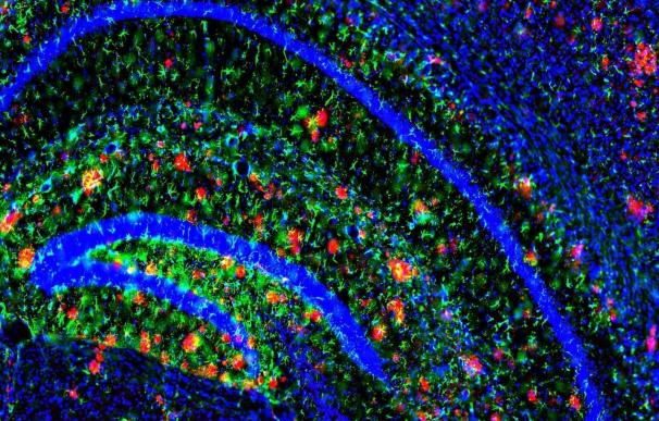 Investigadores revelan cómo las células cerebrales funcionan mal en el Alzheimer