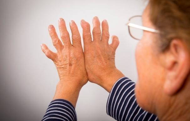 Las personas que trabajan en el sector manufacturero tienen más riesgo de desarrollar artritis reumatoide