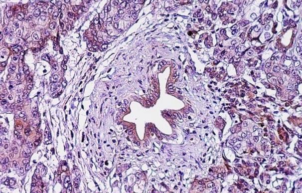 Investigadores diseñan una 'biopsia líquida' para detectar mejor el cáncer pancreático temprano