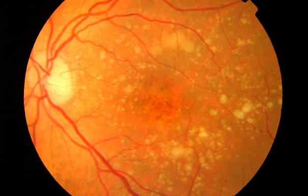 Investigadores identifican potenciales biomarcadores para la degeneración macular asociada a la edad