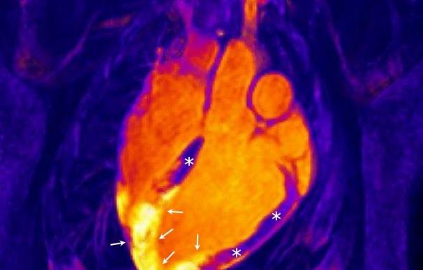Investigadores españoles descubren que el corazón humano no reacciona ante un infarto como se pensaba