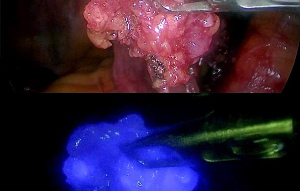 El uso combinado de radiación y fluorescencia aumenta la detección del ganglio centinela en tumores ginecológicos