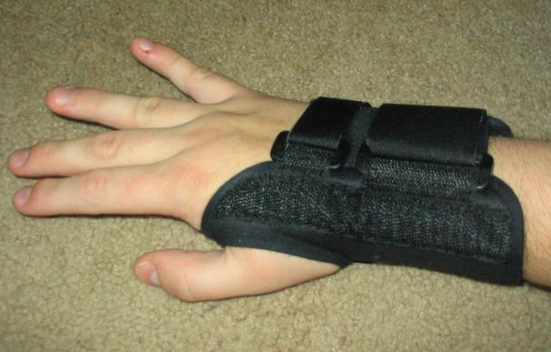 Fotografía de una mano afectada por el síndrome del túnel carpiano.