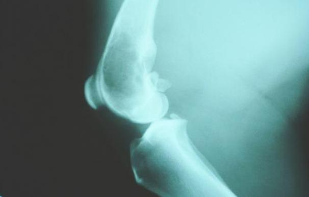 Radiografía de un osteosarcoma en el fémur. / WIKIPEDIA