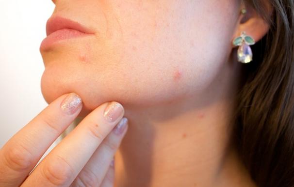 Aparatos para evitar el acné en el rostro