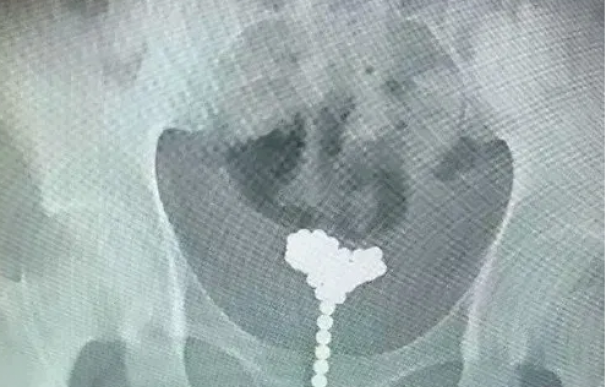 Fotografía de las bolas magnéticas que se introdujo un niño en el pene.