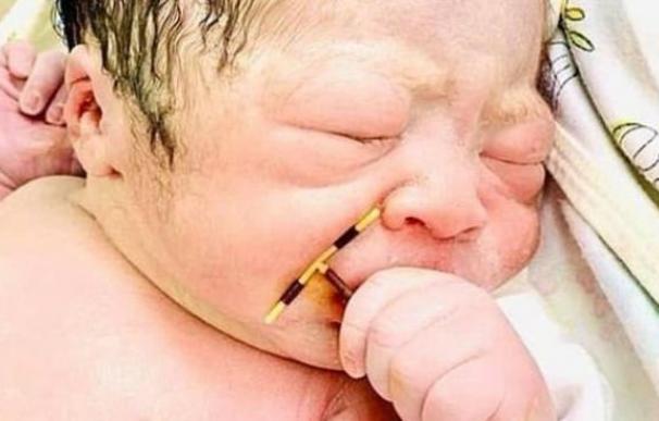 Un bebé nace agarrado al DIU que tenía implantado su madre y se hace viral